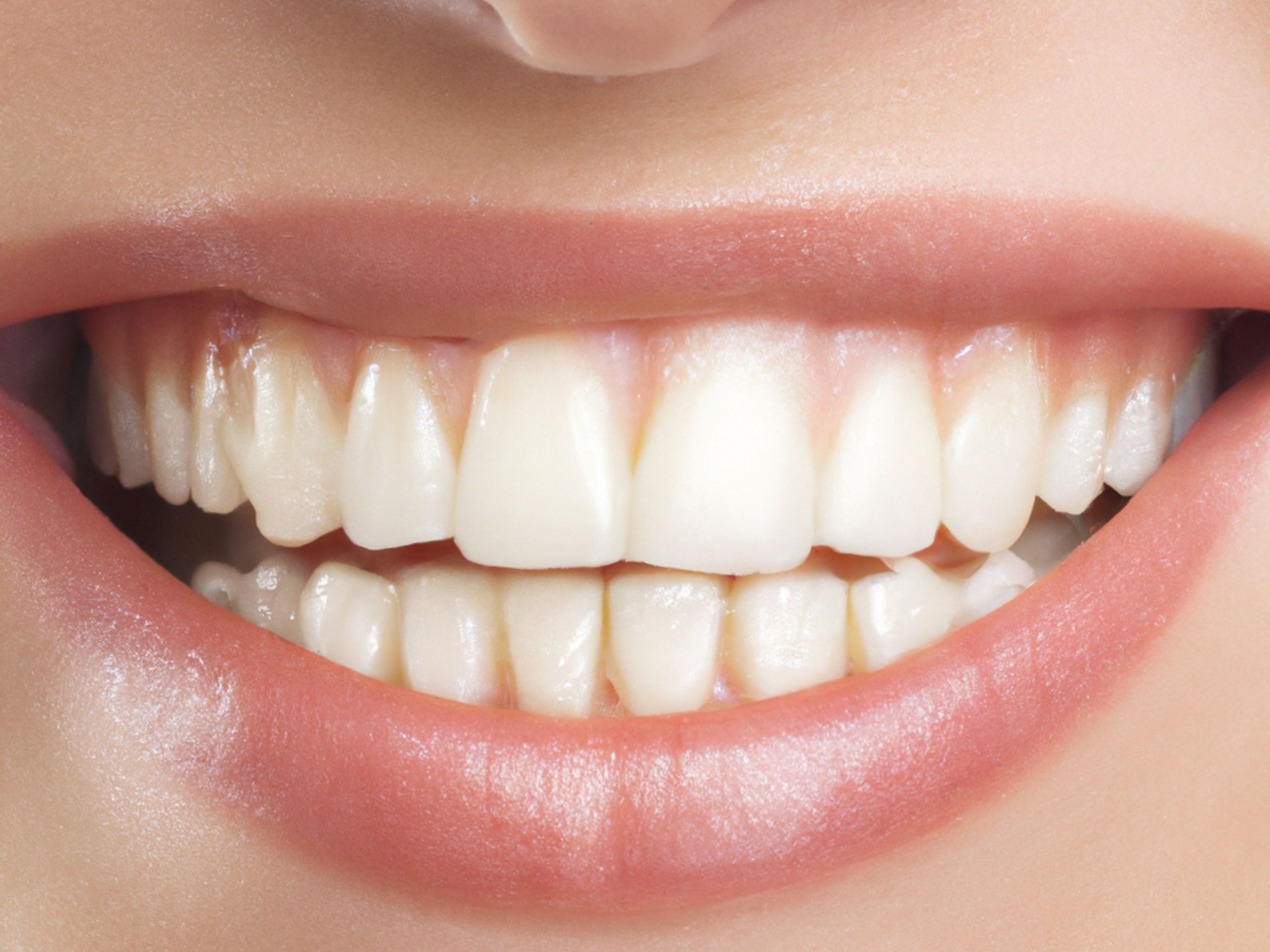 Bright white smile representing professional teeth whitening